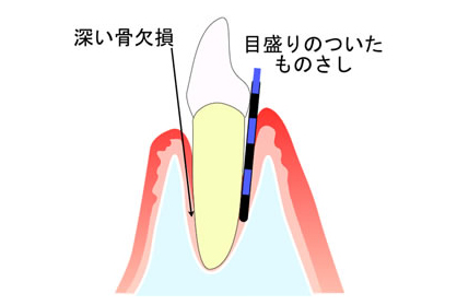 歯周再生治療の流れイメージ
