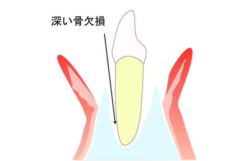 歯周再生治療の流れイメージ