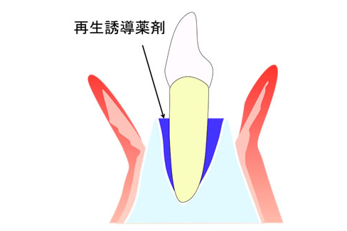 歯周再生治療の流れイメージ