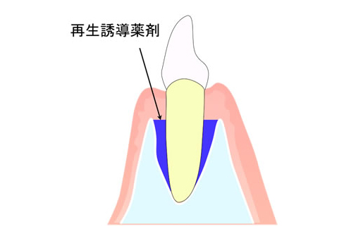 歯周再生治療の流れイメージ